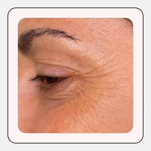 Aging Skin