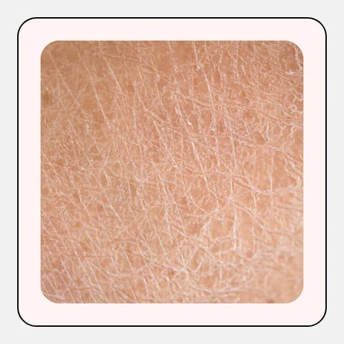 Dry, Tight Skin