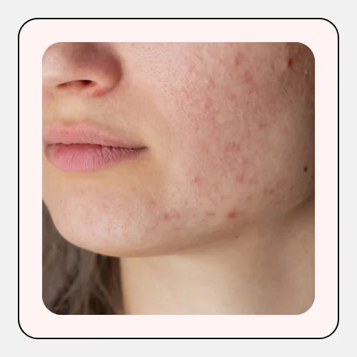 Breakouts